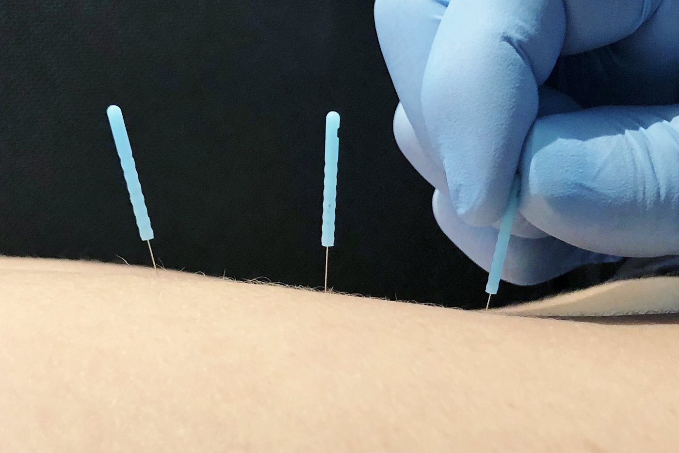 Dry Needling vs. Acupuncture: What's Actually Different