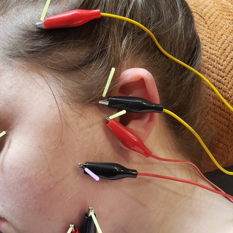 Dry Needling with Dr. Brent Lockett