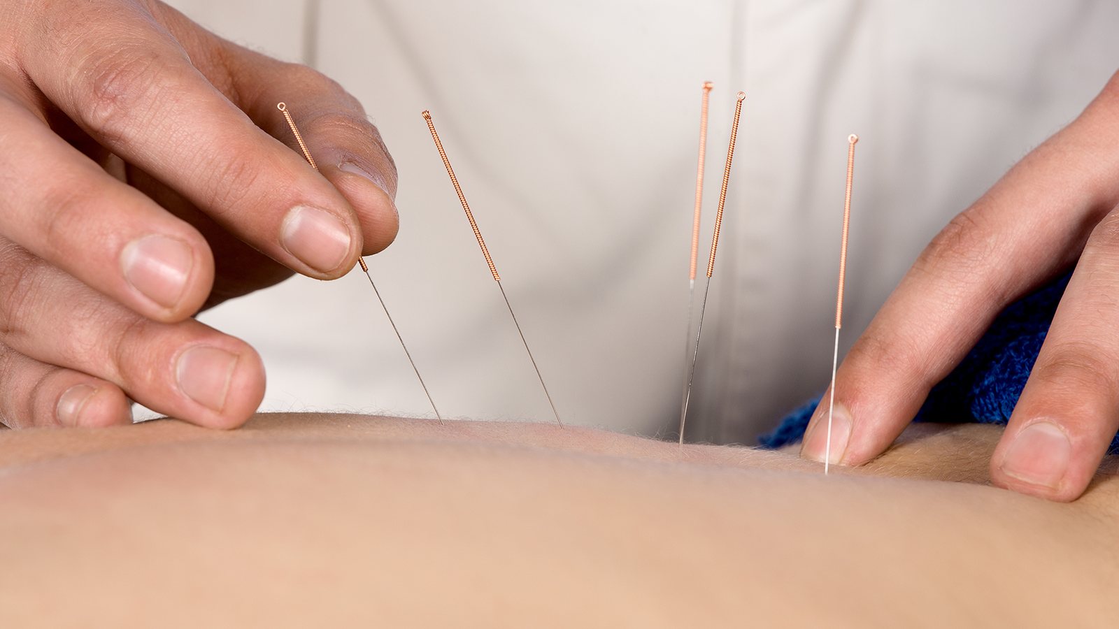 Dry needling treatment of the back